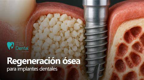 Ilustración de una cirugía de regeneración ósea alrededor de un implante
