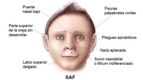 Infografía detallando los rasgos faciales típicos del Síndrome Alcohólico Fetal