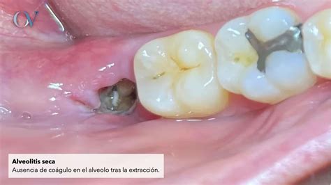 Diagrama de un alveolo dental sano y otro con alveolitis seca