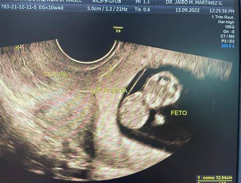 Esquema anatómico que muestra la diferencia entre un embarazo intrauterino normal y las posibles ubicaciones de un embarazo ectópico (trompas de Falopio, ovario, cavidad abdominal).