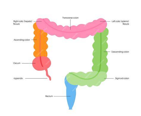 Esquema del intestino grueso con representación del estreñimiento y el efecto del supositorio