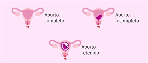 Esquema sobre la definición e incidencia de los abortos de repetición