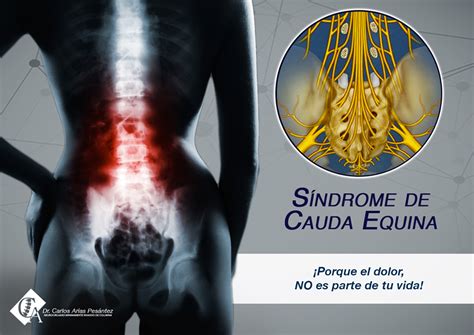 Diagrama que muestra la compresión de las raíces nerviosas en el síndrome de cauda equina