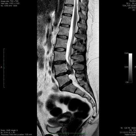 Imagen de resonancia magnética lumbar mostrando una hernia discal masiva
