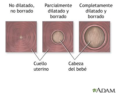 Infografía comparando el cuello uterino cerrado, borrado y dilatado.