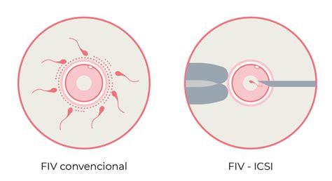 Infografía comparativa entre el mecanismo de fecundación de FIV convencional e ICSI