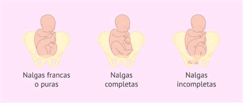 Ilustración de los diferentes tipos de presentación de nalgas: franca, completa e incompleta