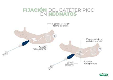 Fotografía de la fijación de un PICC en un neonato