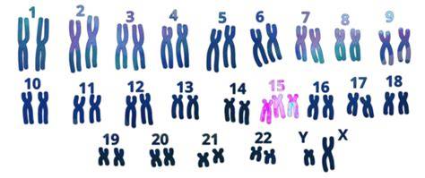 Infografía o esquema que muestra ejemplos de trisomías en los cromosomas 13, 18 y 21