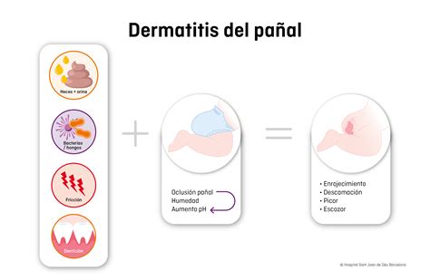 Ilustración de un bebé con dermatitis del pañal, mostrando la zona afectada en glúteos y muslos.
