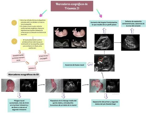 Esquema de translucencia nucal y otros marcadores ecográficos tempranos
