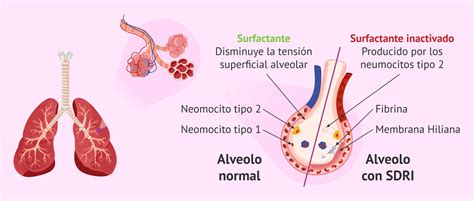 Esquema comparativo del pulmón de un neonato con dificultad respiratoria: a la izquierda, colapso alveolar sin presión; a la derecha, alveolos reclutados mediante CPAP