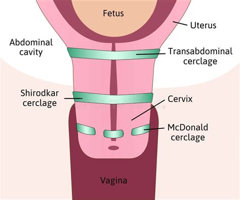 Ilustración médica de un cerclaje cervical