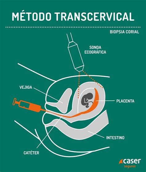 Ilustración detallada de los procedimientos de biopsia corial transcervical y transabdominal