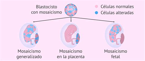 Infografía ilustrando el concepto de mosaicismo confinado a la placenta y su impacto en los resultados de la BVC