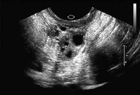 Ecografía transvaginal de un ovario bovino mostrando folículos para la extracción de ovocitos (OPU).
