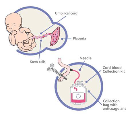 Foto de cordón umbilical recién cortado o bolsa de recolección de sangre de cordón