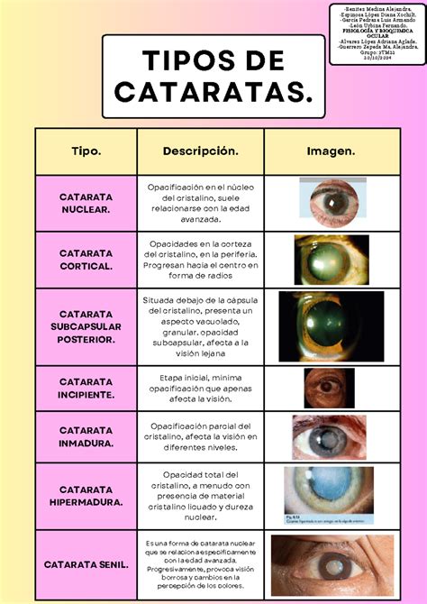 Fotografías clínicas de diversos tipos de cataratas