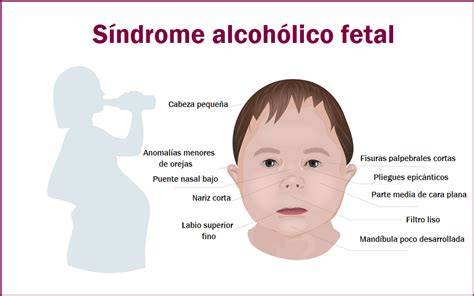 Ilustración de las características faciales y digitales del Síndrome de Hidantoína Fetal