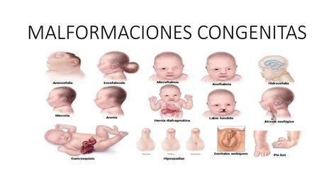 Infografía: principales malformaciones congénitas asociadas al uso de fenitoína durante el embarazo