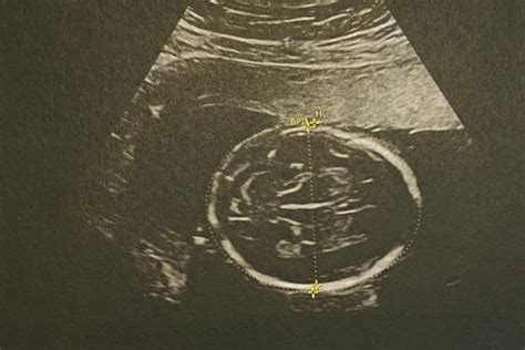 Esquema detallado de la anatomía fetal visible en la ecografía del segundo trimestre