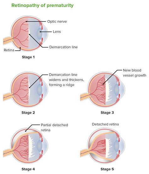 Ilustración médica que muestra el desarrollo de la retinopatía del prematuro en los vasos sanguíneos de la retina.