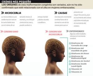 Infografía explicando las causas y consecuencias de la microcefalia en recién nacidos