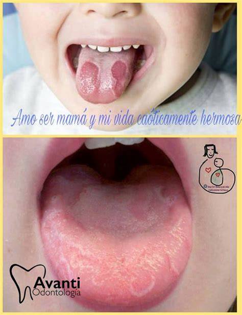 Fotografía comparativa: detalle de la superficie lingual en casos de lengua geográfica frente a lengua pilosa.