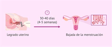 Esquema anatómico mostrando el útero y el procedimiento de legrado uterino por aspiración o curetaje
