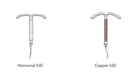 Ilustración de un DIU de cobre y un DIU hormonal en el útero