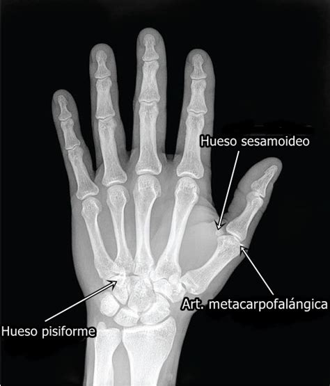 Esquema del pulgar del panda (sesamoideo radial) como ejemplo de exaptación
