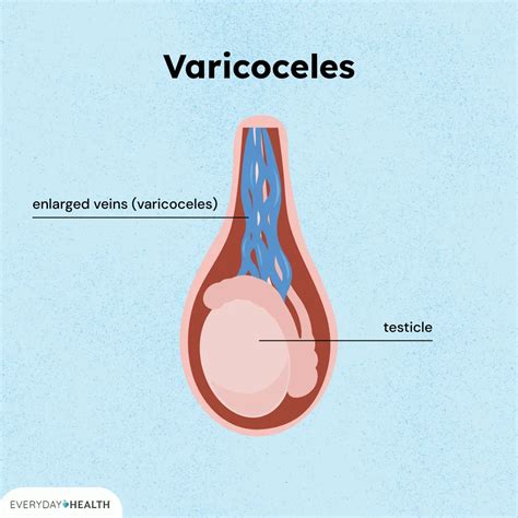 Ilustración de un varicocele testicular