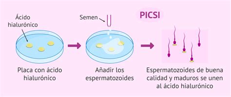 Esquema comparativo de selección de espermatozoides en ICSI tradicional y PICSI
