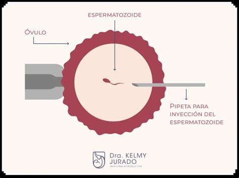 Esquema de microinyección de espermatozoide en un óvulo (ICSI)