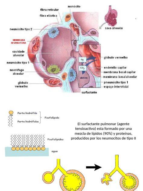 Esquema médico sobre el desarrollo pulmonar inmaduro y el papel del surfactante en el intercambio gaseoso.