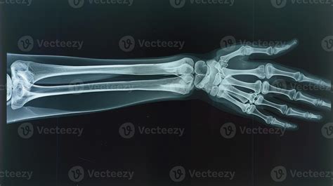 Radiografía de un hueso de bebé mostrando desmineralización o fractura