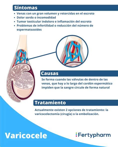 Infografía: decisiones de tratamiento para el varicocele
