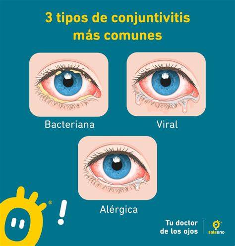 Ilustración de un ojo con conjuntivitis bacteriana
