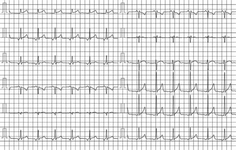 Electrocardiograma basal que muestra ritmo sinusal con PR corto y ondas P negativas en la cara inferior, compatibles con ritmo auricular bajo.