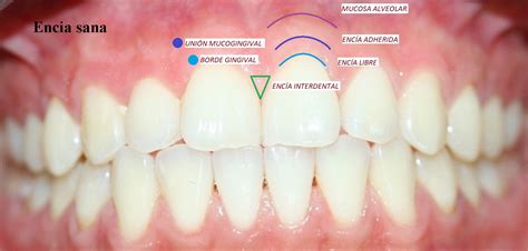 Esquema: Diferencia entre encía sana y encía con gingivitis