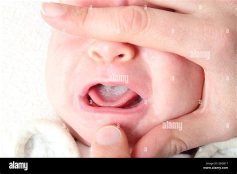 Imagen de bebé con muguet oral