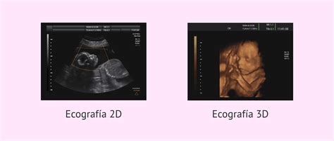 Infografía comparativa de ecografía 2D y 3D