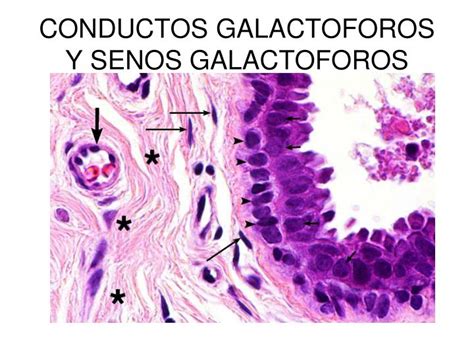 Ilustración de un conducto galactóforo obstruido