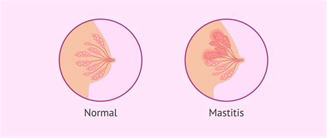 Diferencias visuales entre conducto obstruido, mastitis y absceso mamario