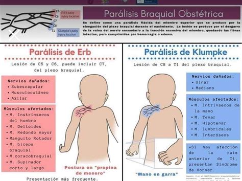 Representación de los diferentes tipos de parálisis braquial obstétrica