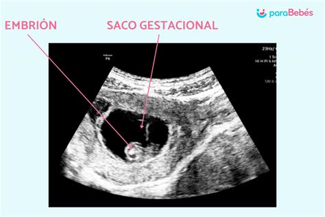 Ecografía mostrando la ausencia de saco gestacional en el útero y posible hallazgo de masa extrauterina.