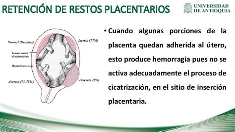 Esquema de útero con restos placentarios retenidos