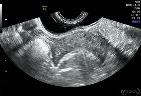 Ecografía transvaginal mostrando restos placentarios vascularizados