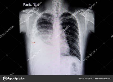 Radiografía de tórax de una niña con neumonía cavitada, empiema, derrame pleural y cardiomegalia