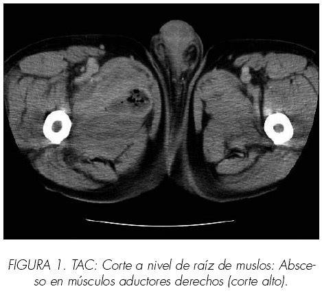 Ilustración de piomiositis múltiple con abscesos musculares